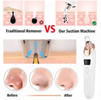 5-in-1 Blackhead Remover | Clear Skin in Seconds