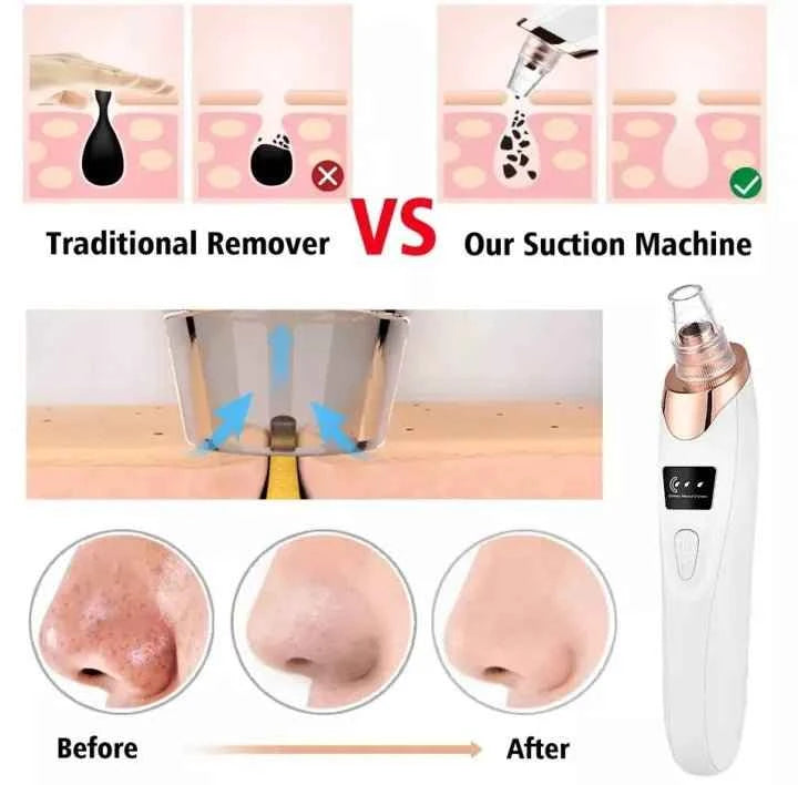 5-in-1 Blackhead Remover | Clear Skin in Seconds