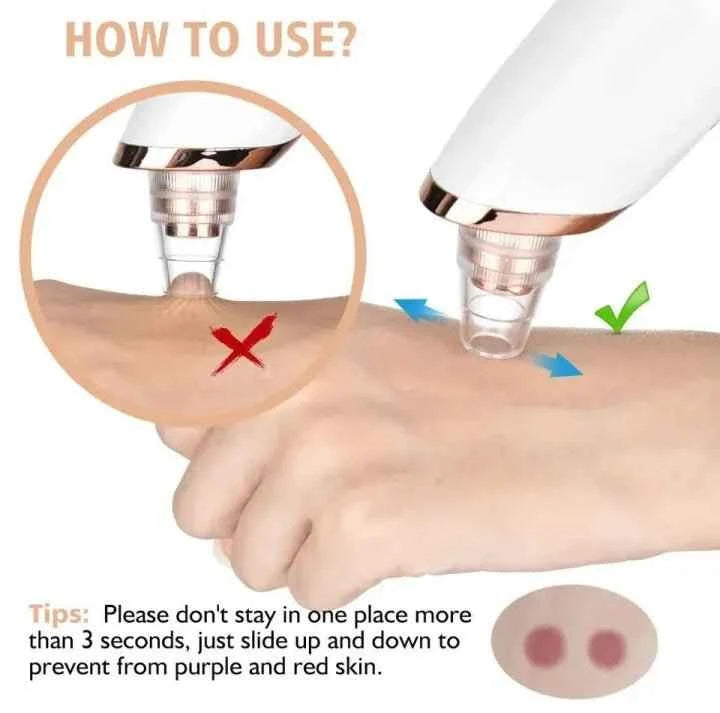 5-in-1 Blackhead Remover | Clear Skin in Seconds